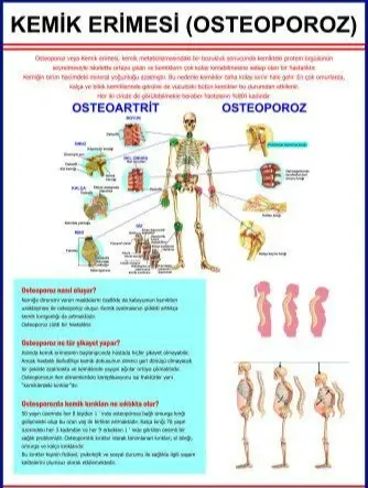 Osteoporoz Eğitim Plakası (KEMİK ERİMESİ)