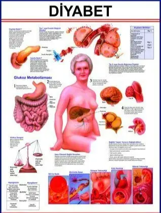 DİYABET LEVHASI