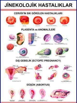 Jinekolojik Hastalıklar Eğitim Plakası