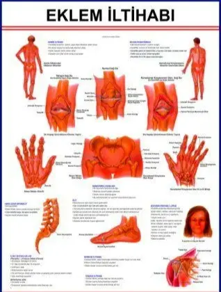 EKLEM İLTİHABI LEVHASI