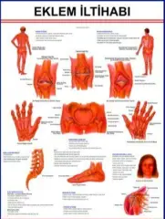 EKLEM İLTİHABI LEVHASI